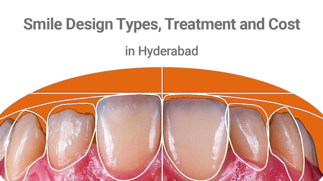 What Is Smile Design Types Treatment Its Cost