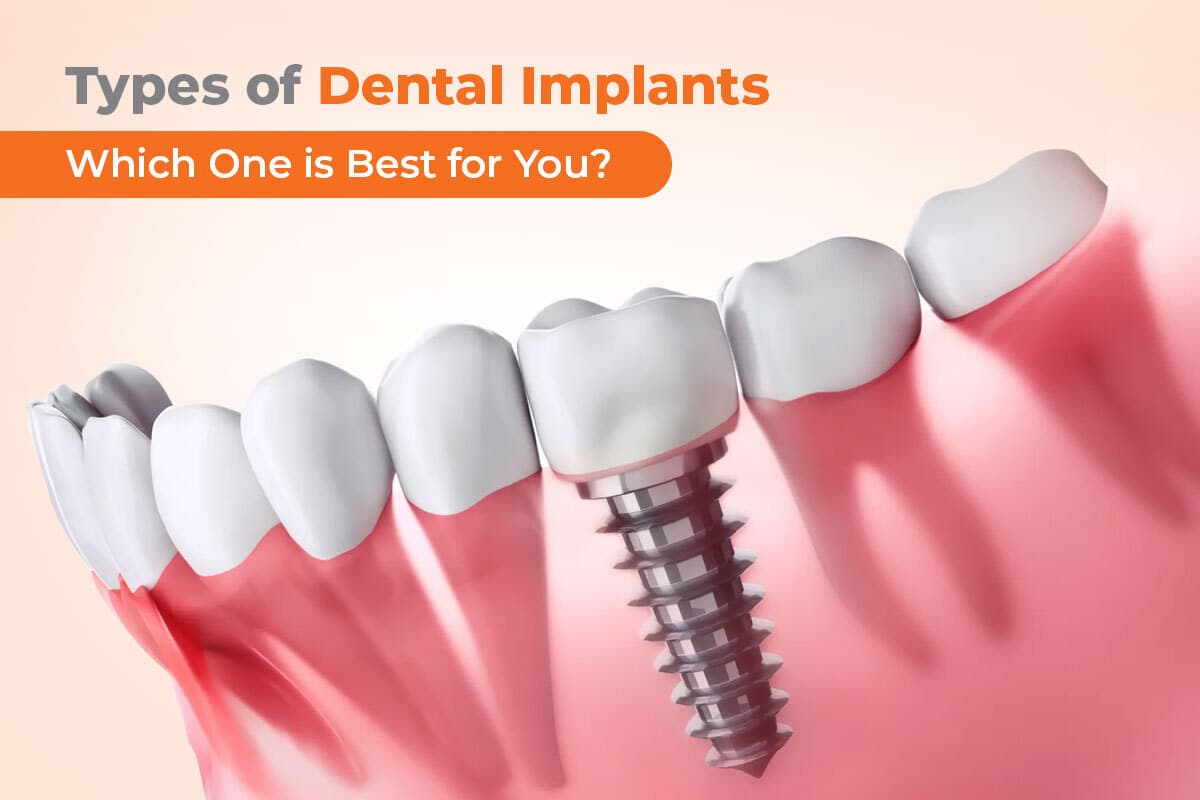 Types Of Dental Implants And Which One Is Best For You