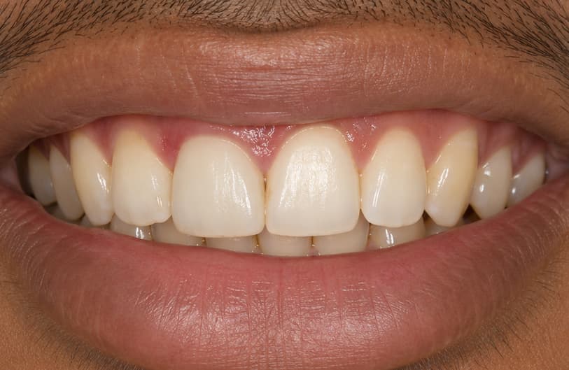 After - RCT Before