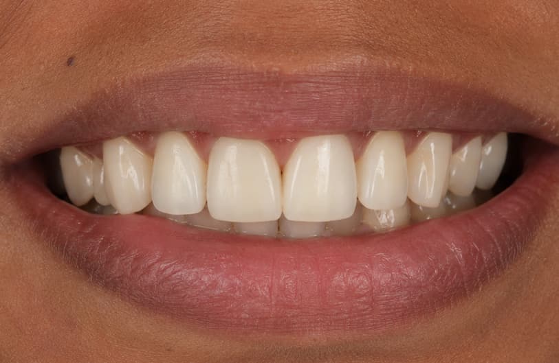 After - RCT Before