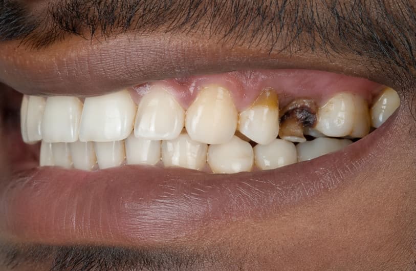 Before - RCT Before