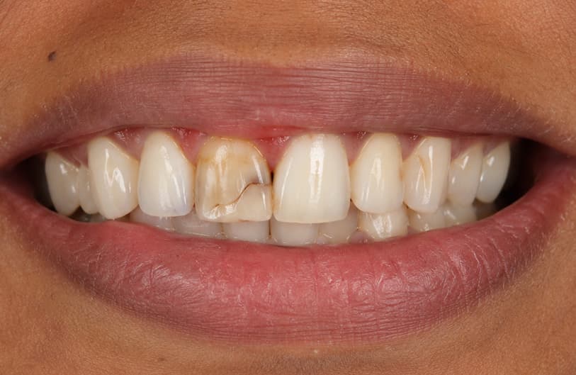 Before - RCT Before