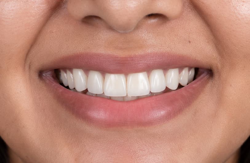 After - Smile Makeover before