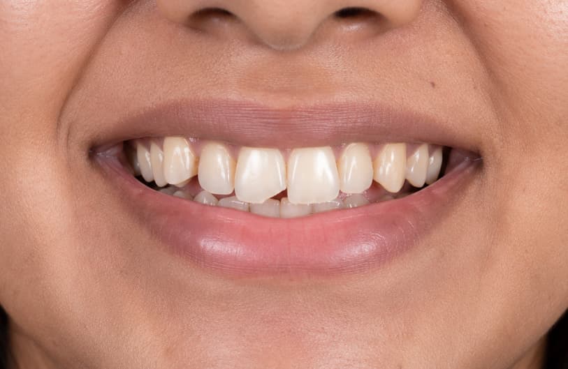 Before - Smile Makeover before