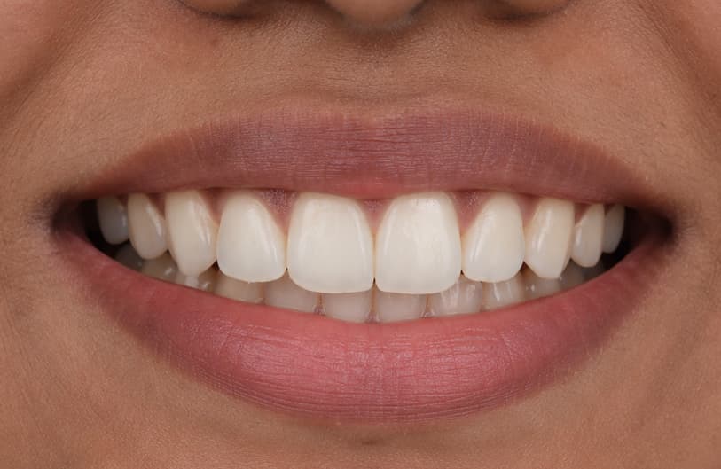 After - Teeth Gap Before