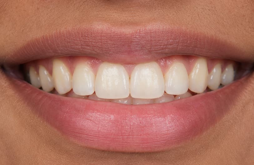After - Teeth Gap Before