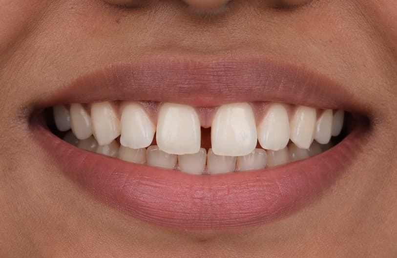 Before - Teeth Gap Before