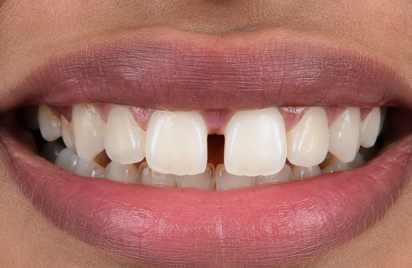 Before - Teeth Gap Before