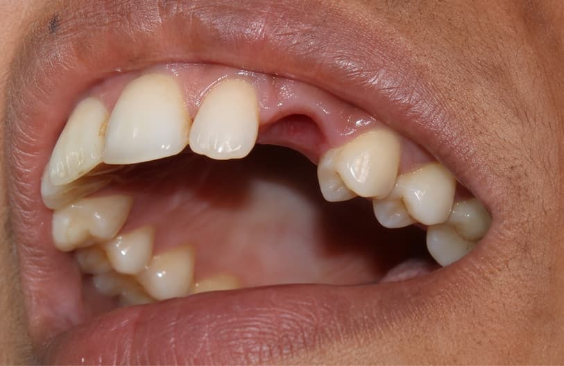 After - atraumatic extraction before