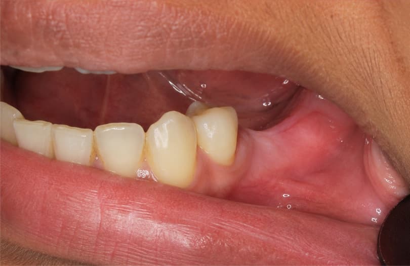 After - atraumatic extraction before