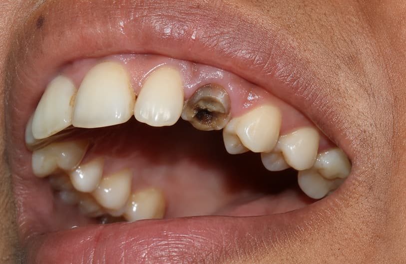 Before - atraumatic extraction before