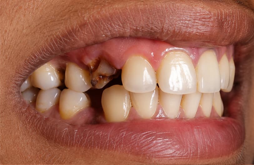 Before - atraumatic extraction before
