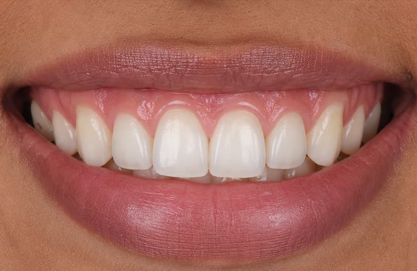 After - laser gum treatment before