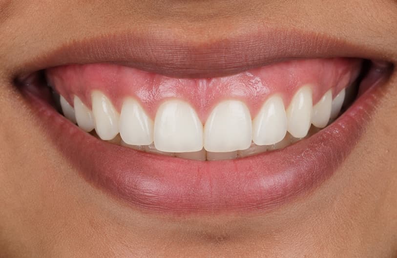 After - laser gum treatment before