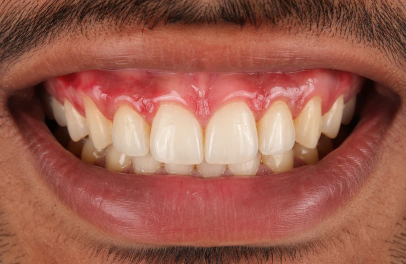 Before - laser gum treatment before