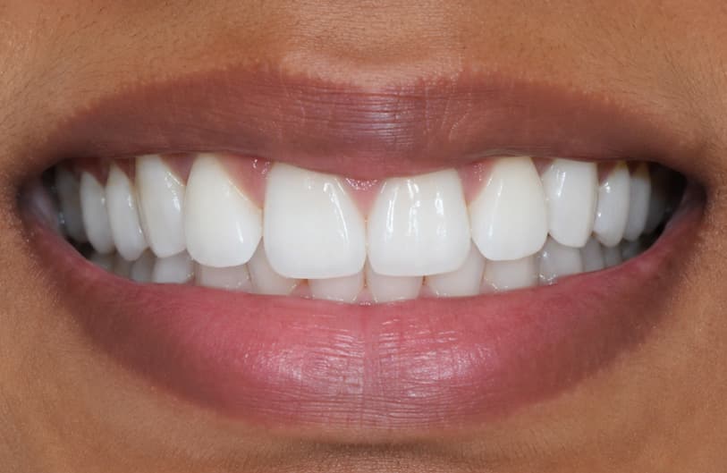 After - teeth whitening before