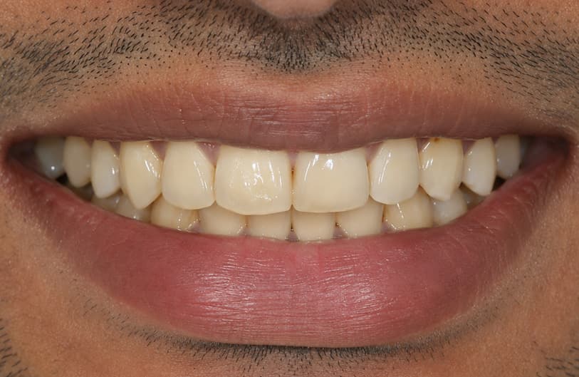 Before - teeth whitening before