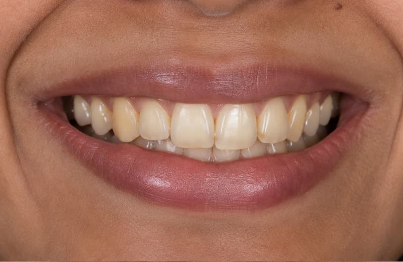 Before - teeth whitening before