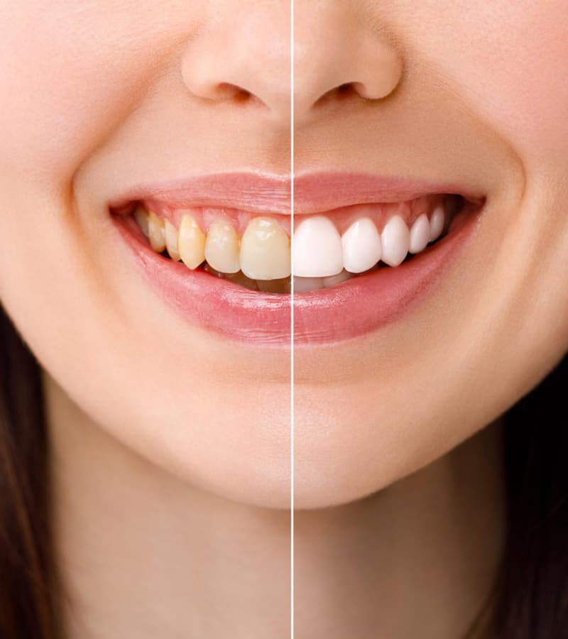 what-is-teeth-whitening