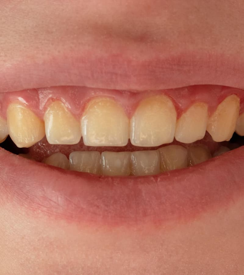 who-is-for-teeth-whiteining