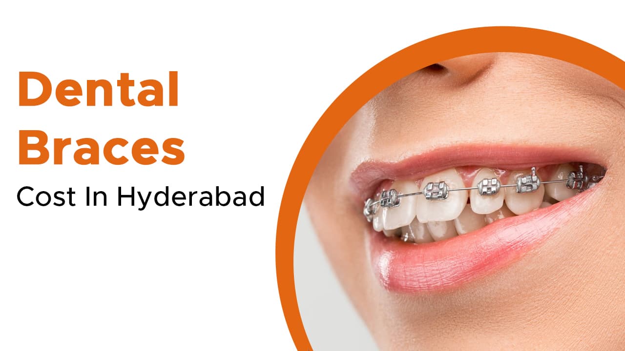 Dental Braces Cost In Hyderabad
