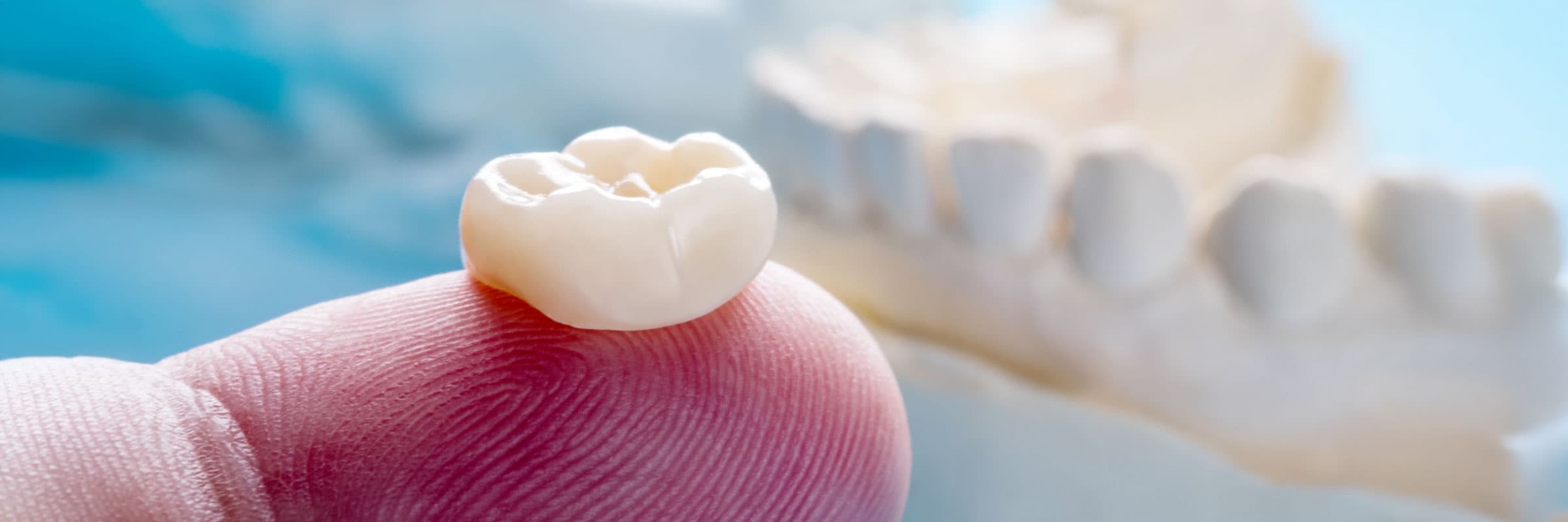 dental-cap-treatment-in-hyderabad