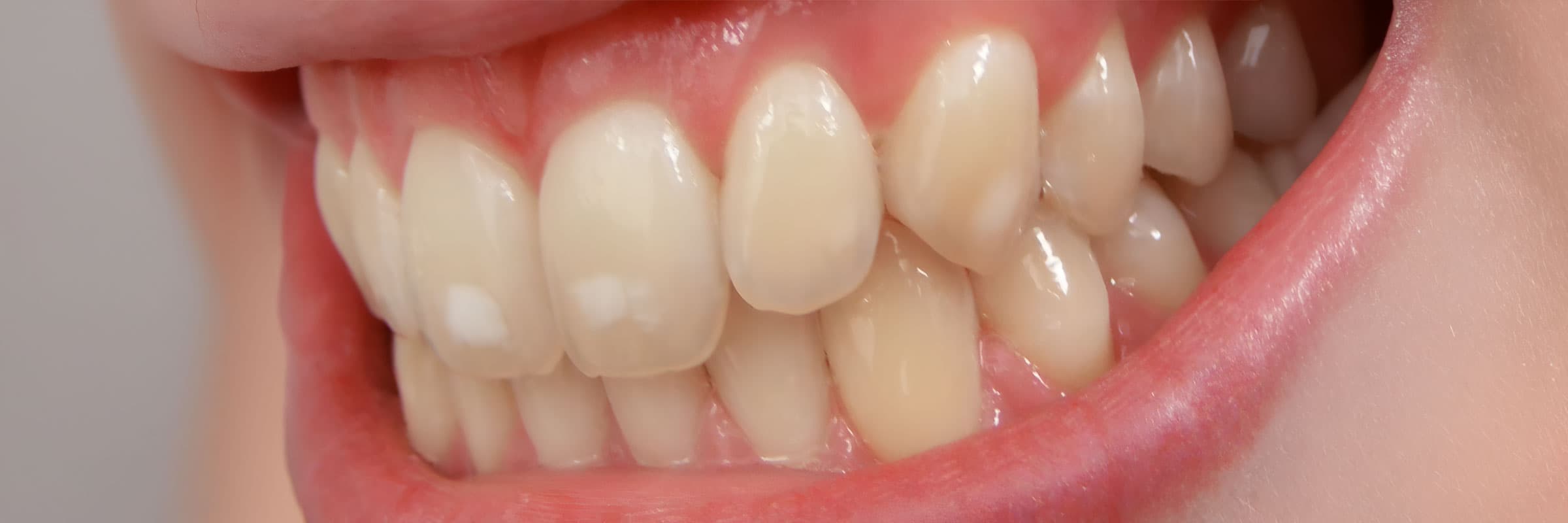 dental-fluorosis-treatment