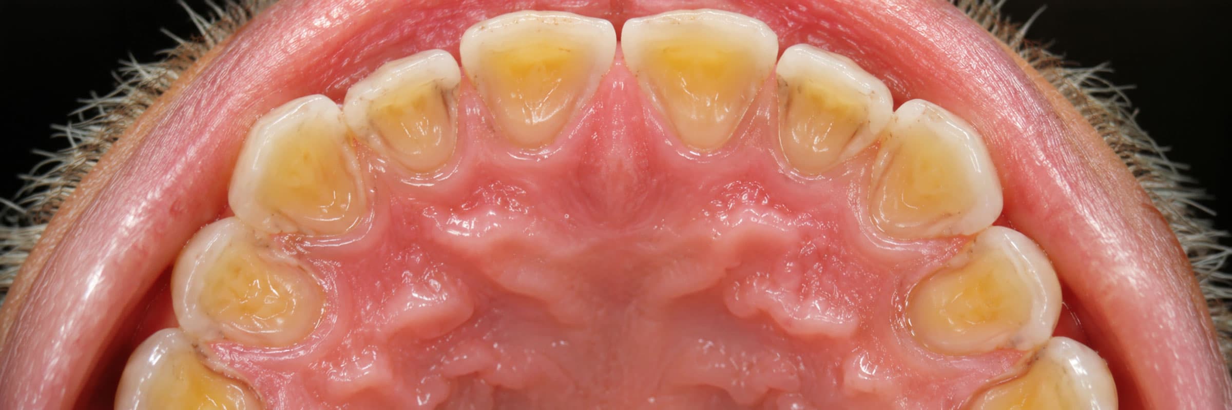 dental-erosion-treatment