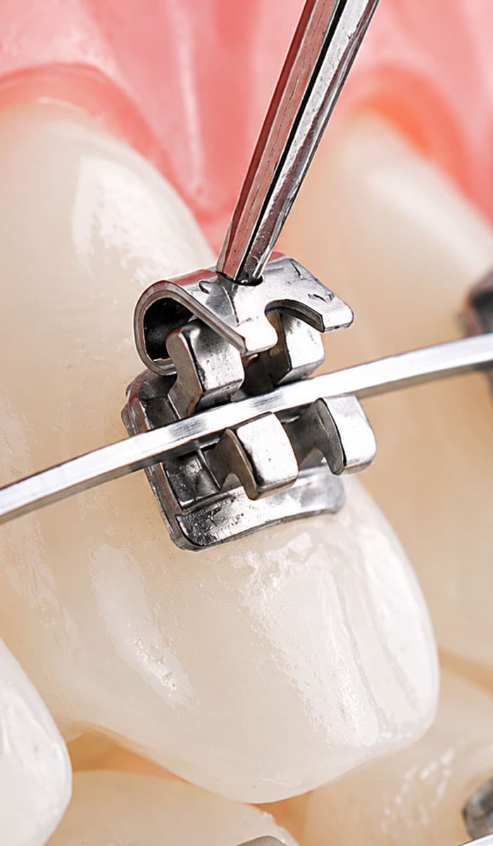 self-ligating-clip-system