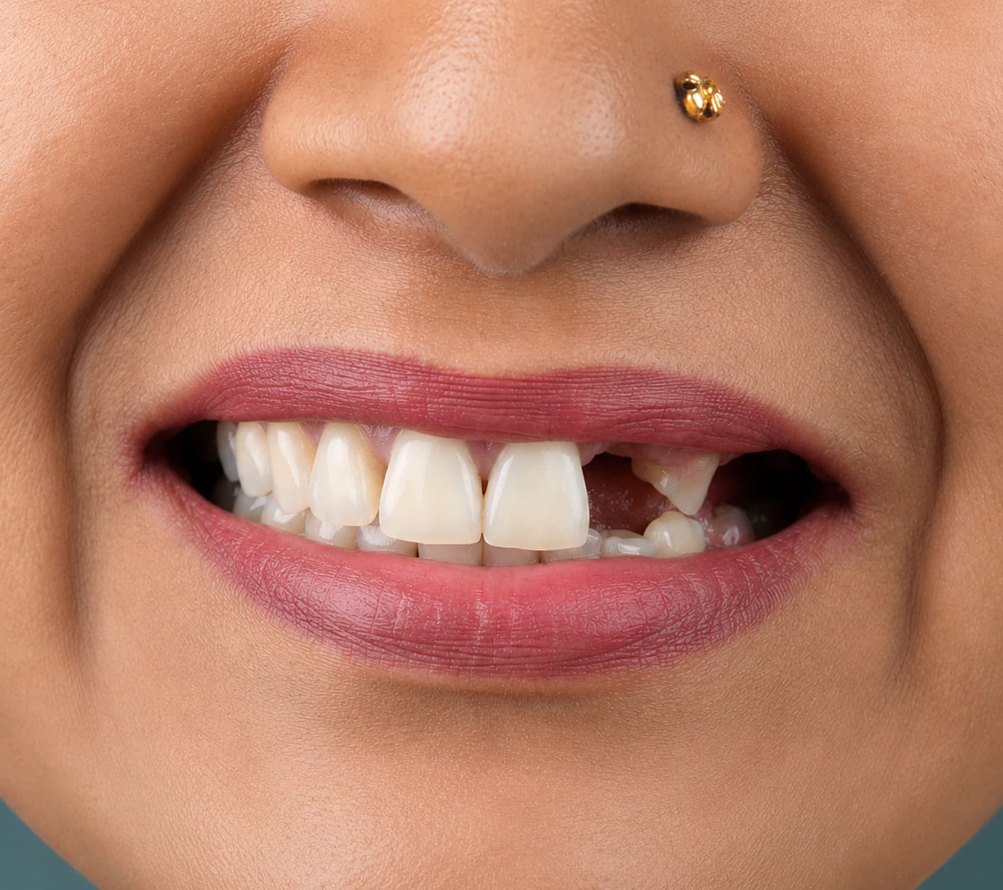 signs-you-may-need-flexi-dentures