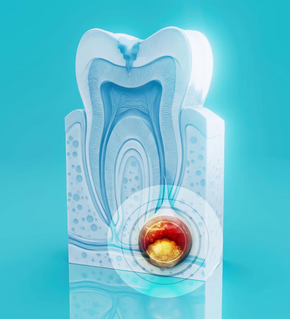 what-causes-a-dental-abscessa