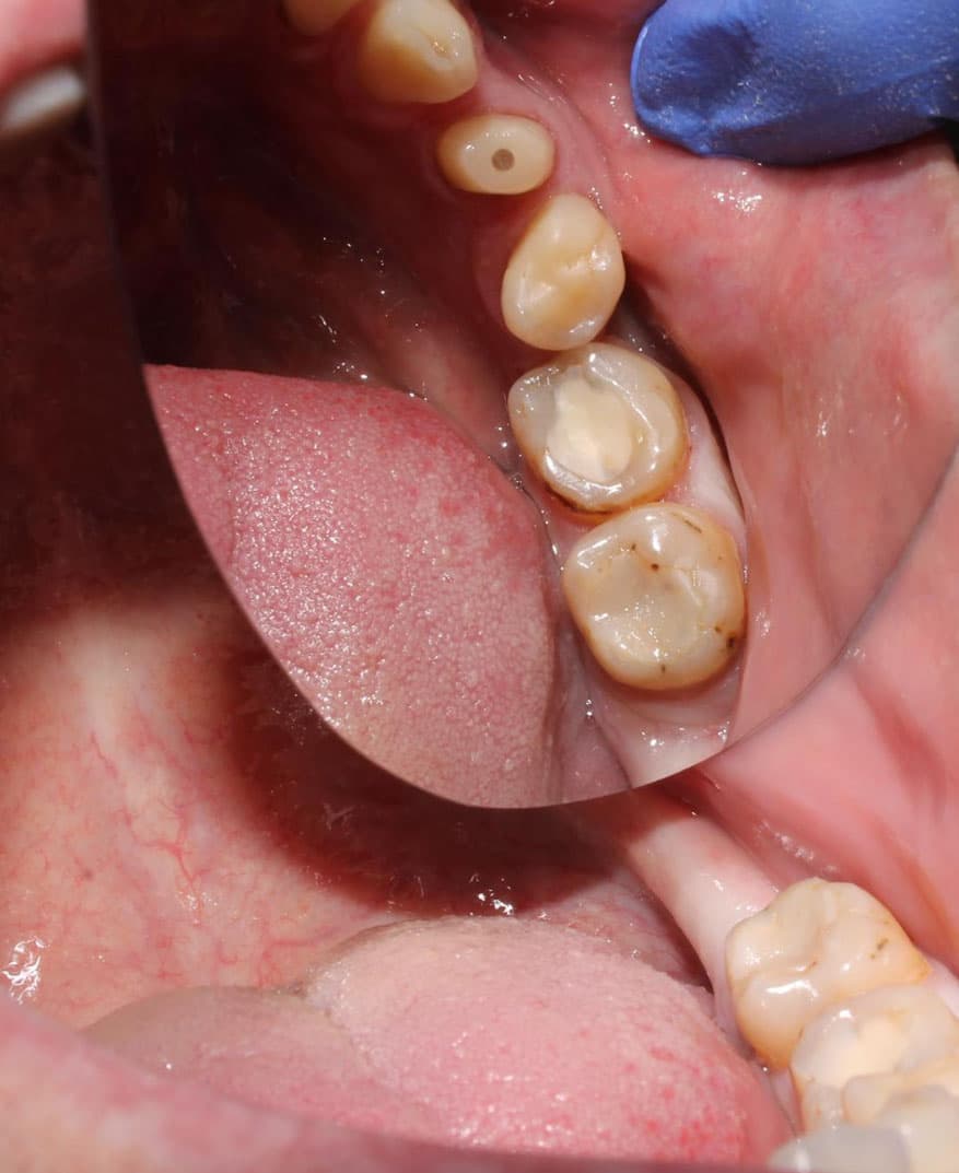 what-is-dental-erosion-treatment