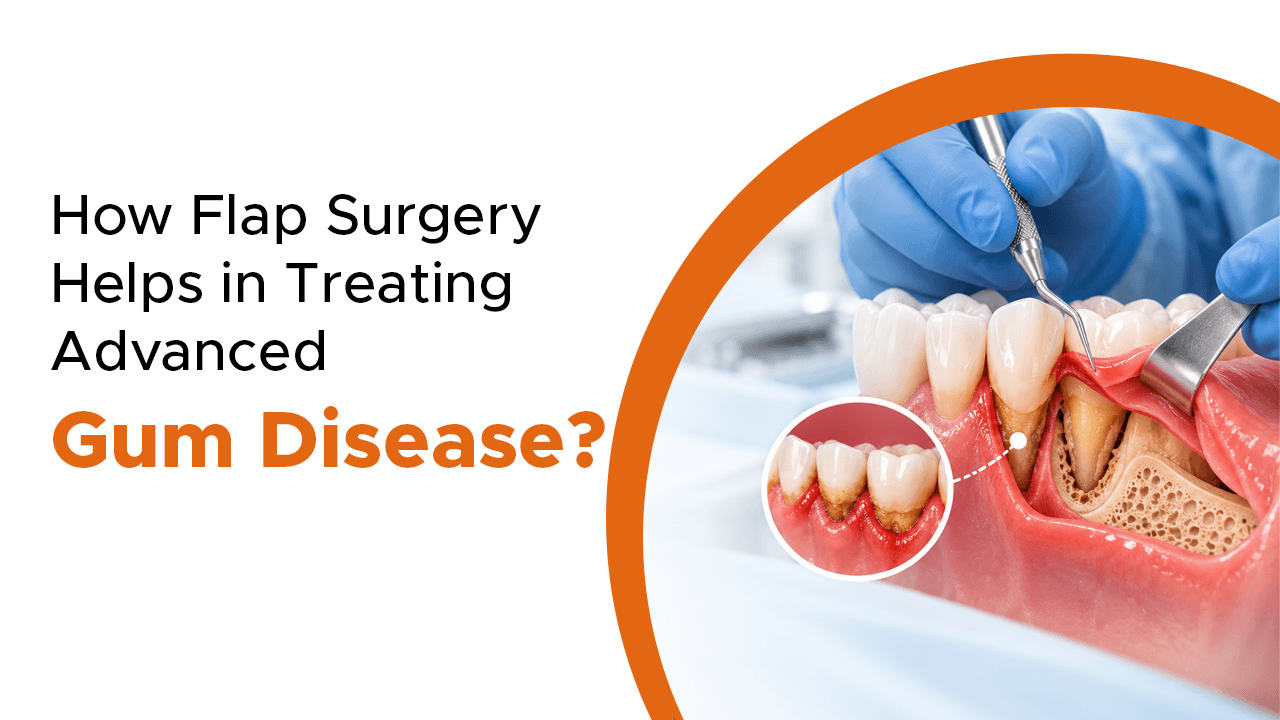 How Flap Surgery Helps In Treating Advanced Gum Disease