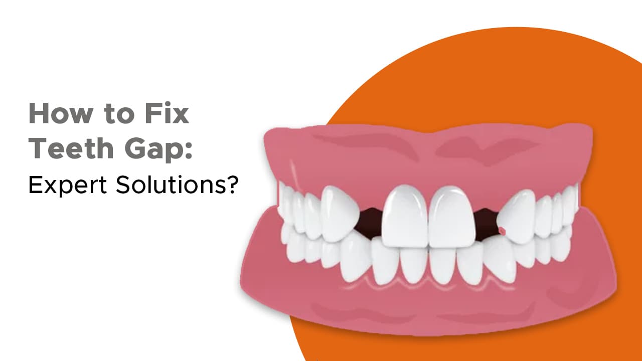 How To Fix Teeth Gap Expert Solutions