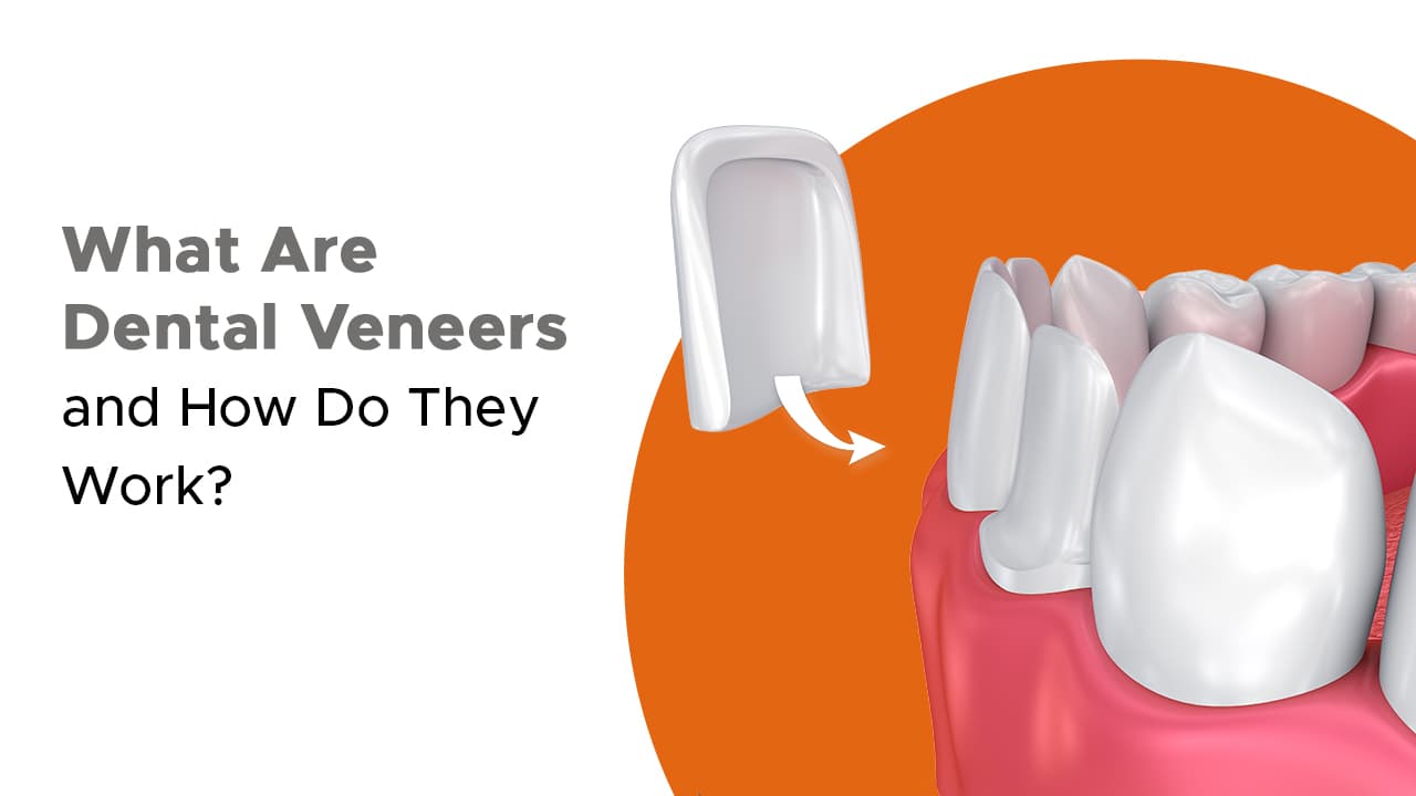 What Are Dental Veneers And How Do They Work