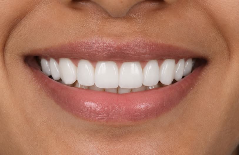 After - Smile Makeover before