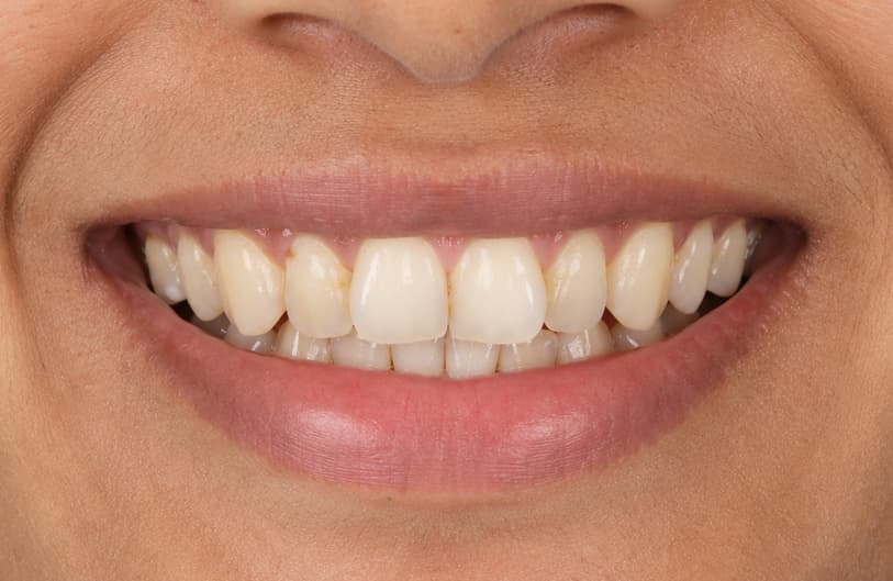Before - Smile Makeover before