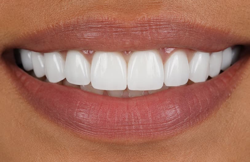 After - dental veneers before