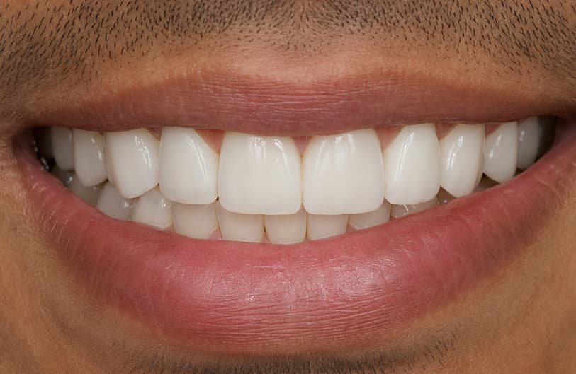 After - dental veneers before