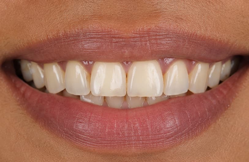 Before - dental veneers before