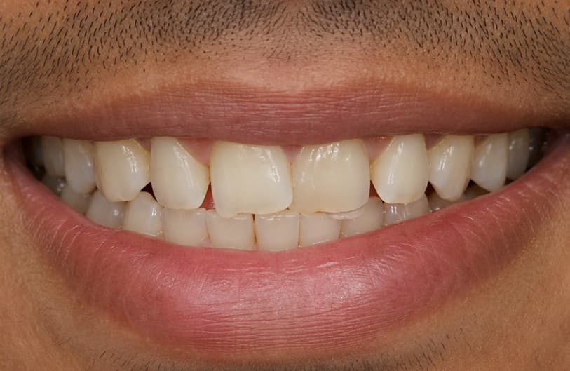 Before - dental veneers before