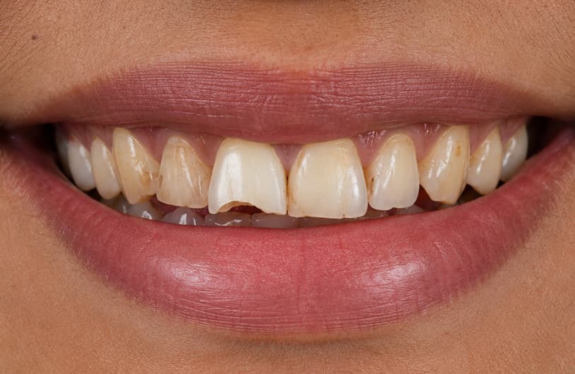 Before - dental veneers before