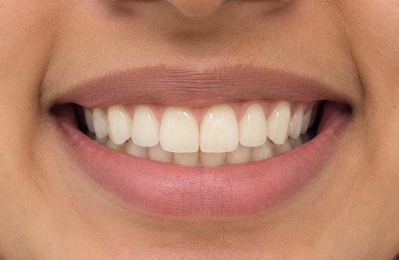 After - orthodontic treatment before
