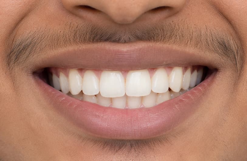 After - orthodontic treatment before