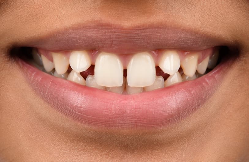 Before - orthodontic treatment before