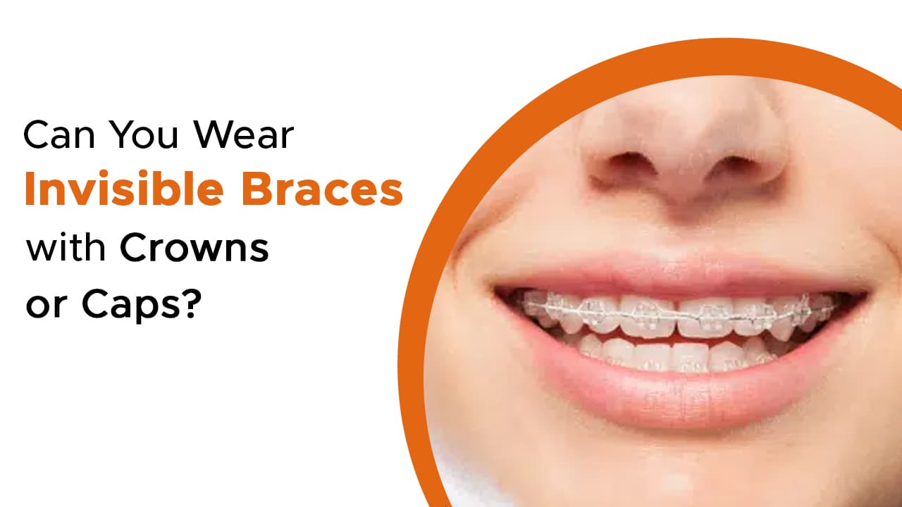 Can You Wear Invisible Braces with Crowns or Caps?