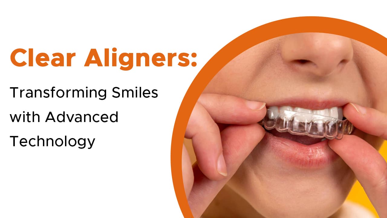 Clear Aligners: Transforming Smiles with Advanced Technology