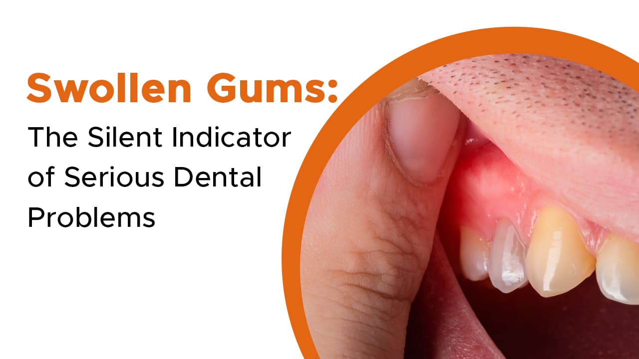 Swollen Gums: The Silent Indicator of Serious Dental Problems