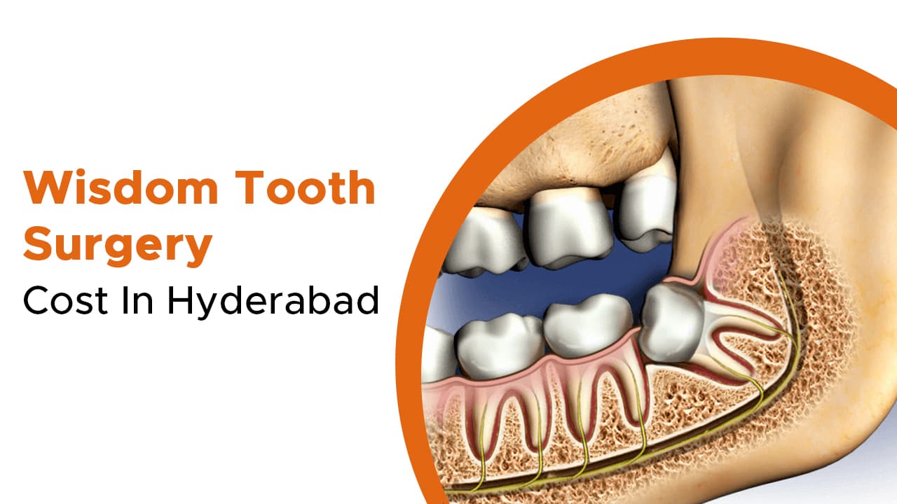 Wisdom Tooth Surgery Cost In Hyderabad