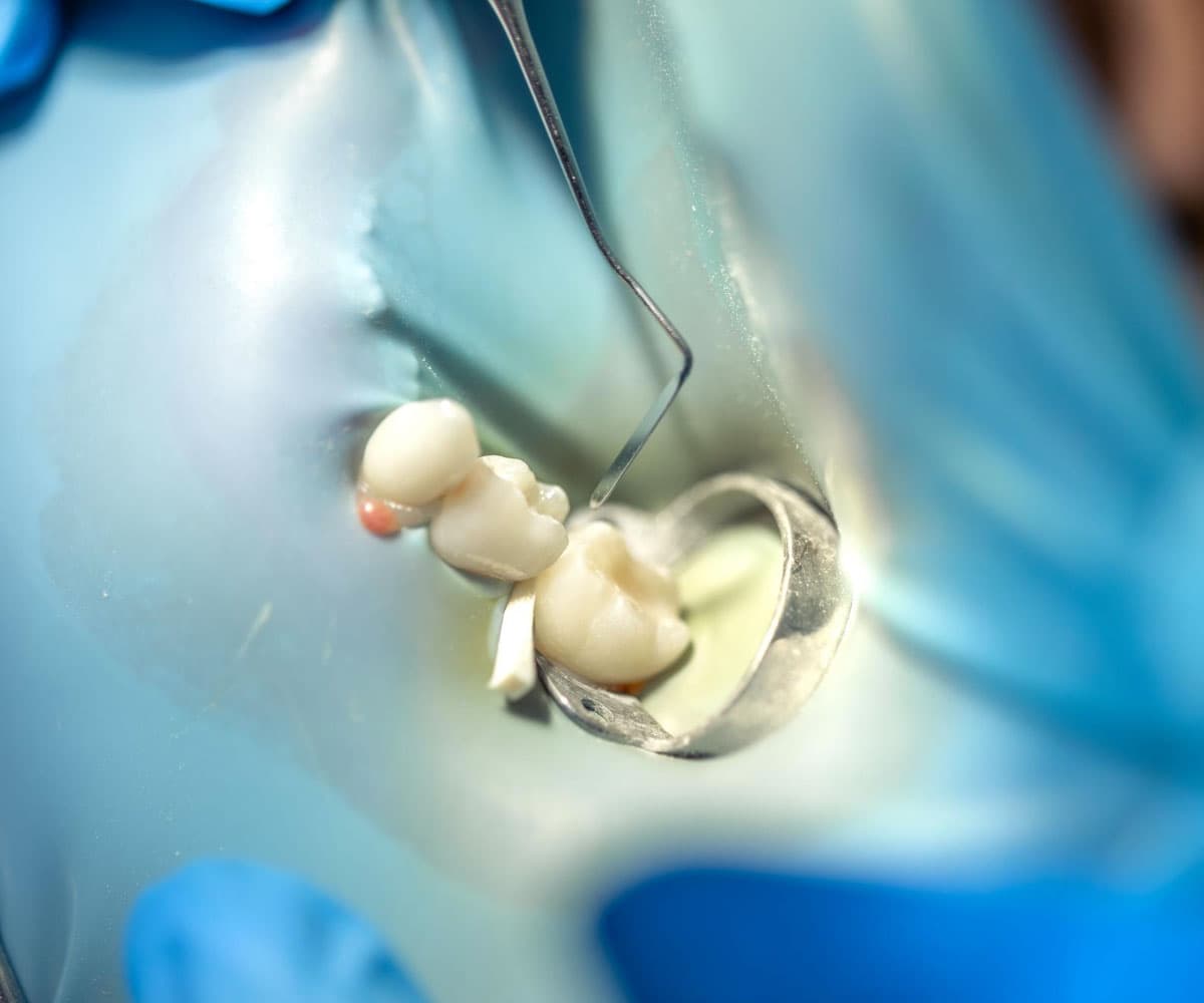 dental-cap-treatment-cost-in-hyderabad